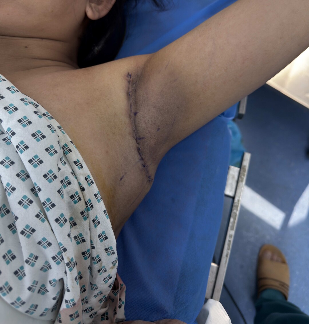 surgery arm - After